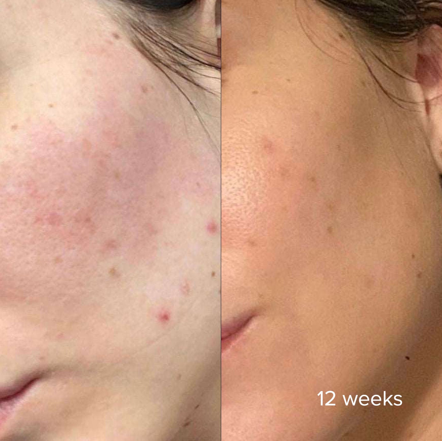 Plump - Hyaluronic Serum